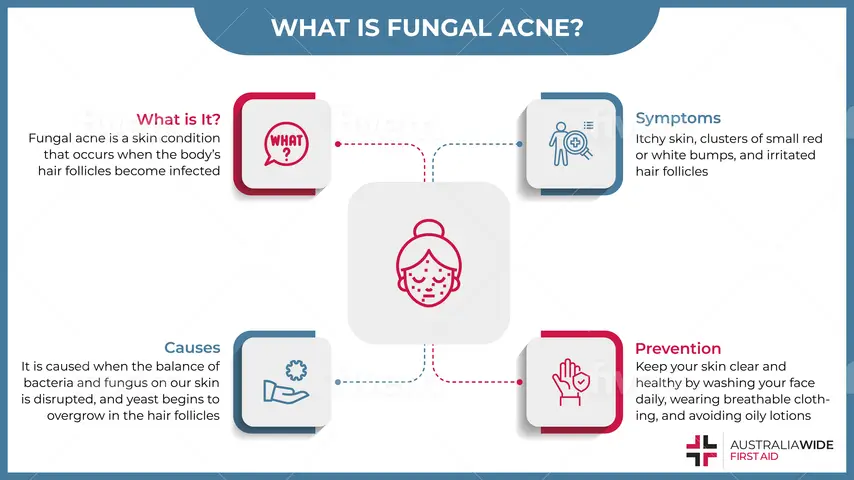 Infographic on Fungal Acne Causes, Symptoms, and Treatment